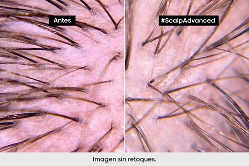 Scalp Advanced champú anti malestar - Los virales del momento | L'Oréal Partner Shop