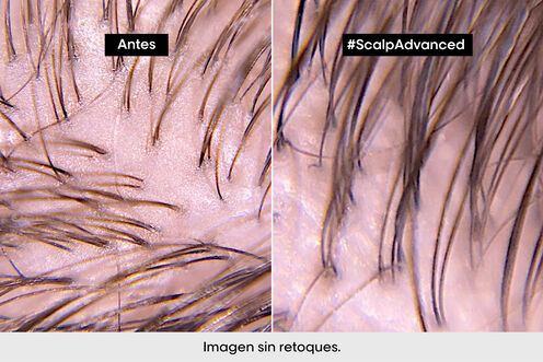 Scalp Advanced champú anti grasa - Los virales del momento | L'Oréal Partner Shop