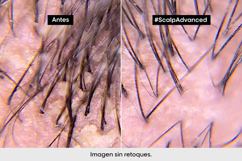 Scalp Advanced champú anticaspa - Los virales del momento | L'Oréal Partner Shop